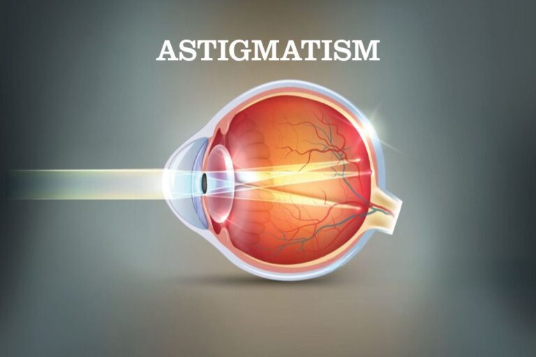 ASTIGMATISM