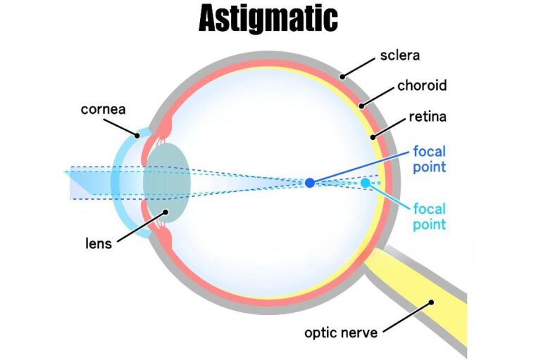 Understanding Astigmatism